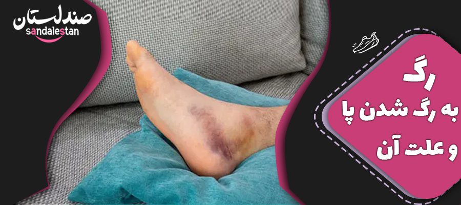 رگ به رگ شدن پا و علت آن